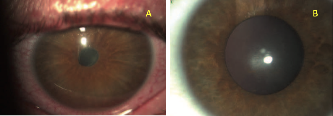 iridociclite