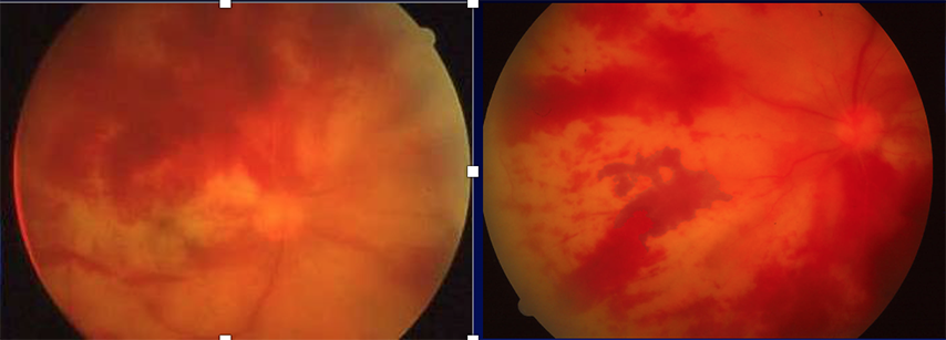 Retinite necrotizzante da herpe zoster copia