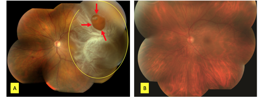 Distacco di retina 