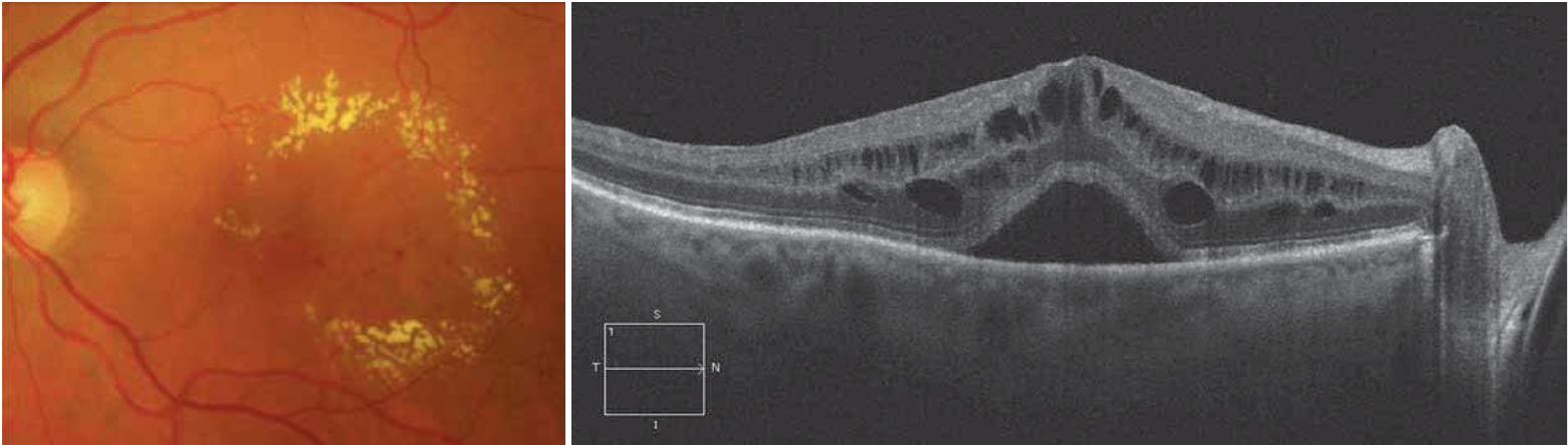 EMD edema mac diabetico