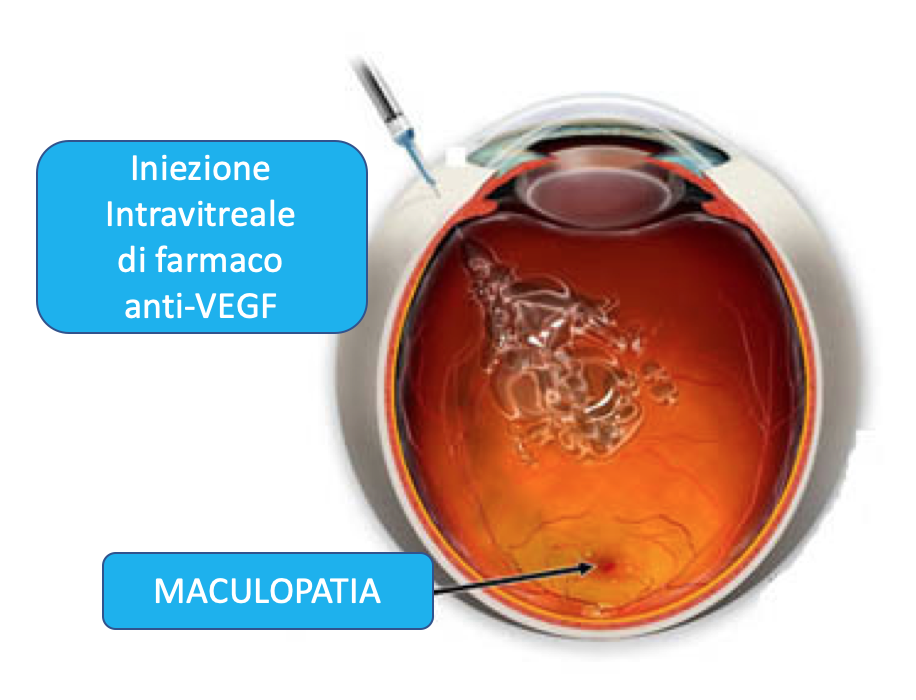 Intravitreale