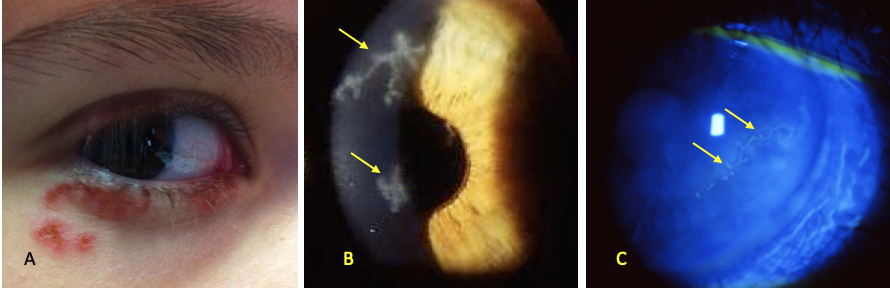 herpes cite cornea